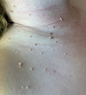 skin tags b4.jpg