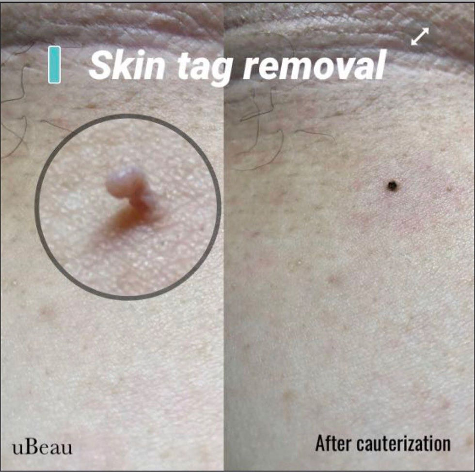 Skin Tag Removal