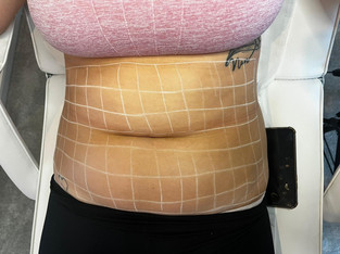 Lady having aesthetics treatment.JPEG