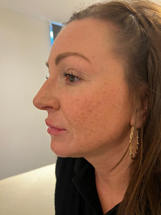 Before pic of woman having lip fillers.JPEG