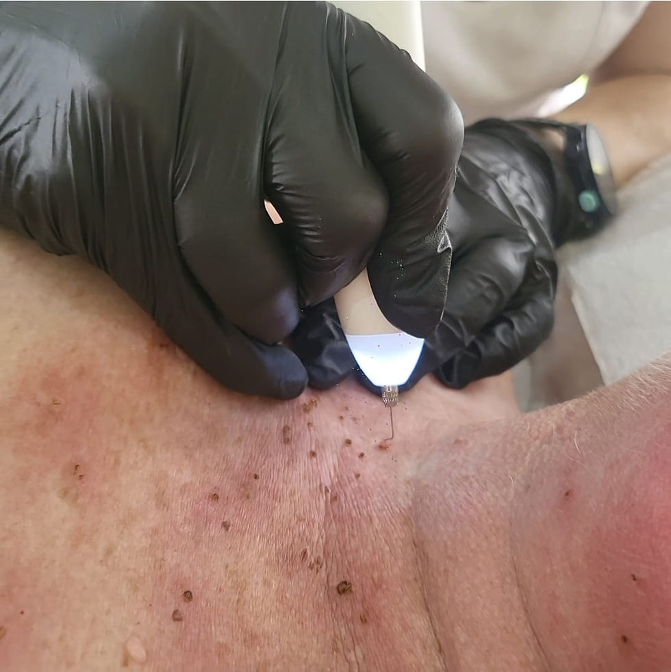 Skin Tag Removal | 30min