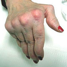 Artritis reumatoide crónica