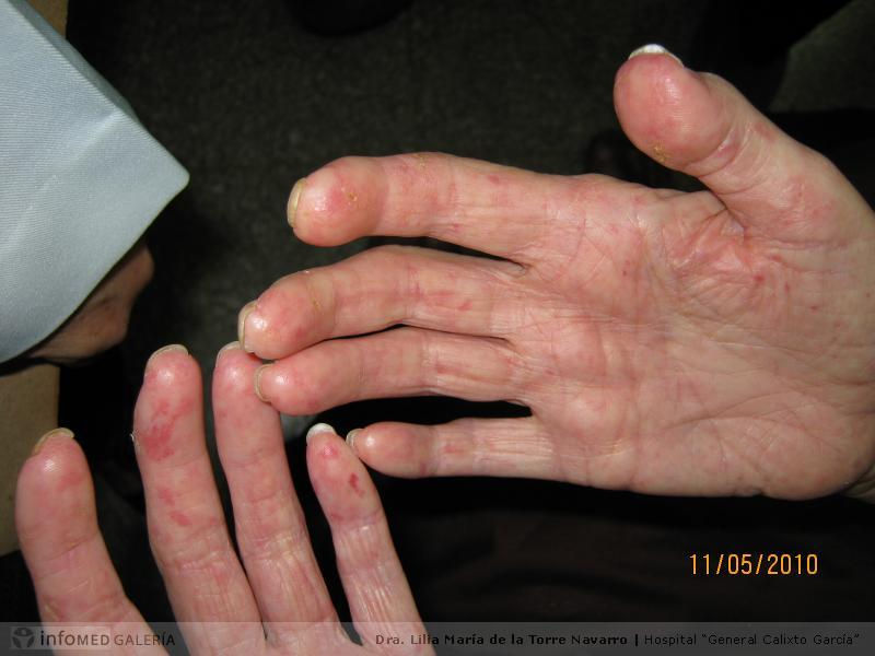 Esclerodermia+difusa.jpg