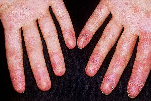 vasculitis digital