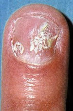 Artritis+psoriásica.jpg