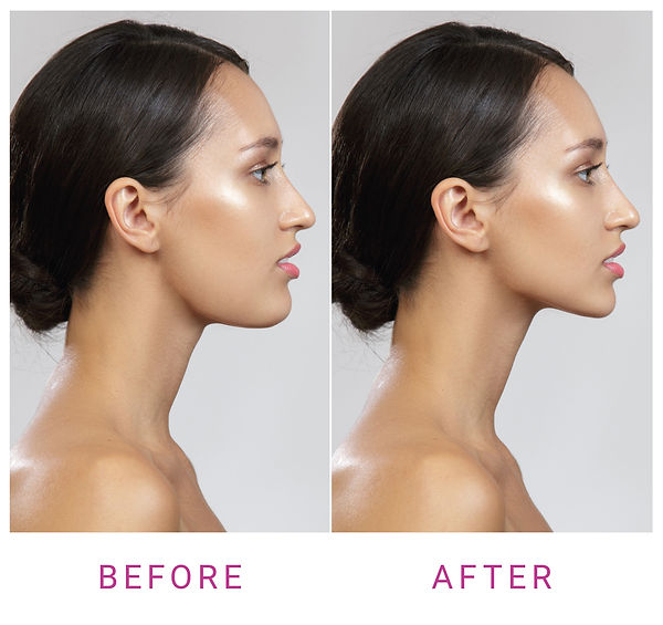 Berfore & After chin.jpg