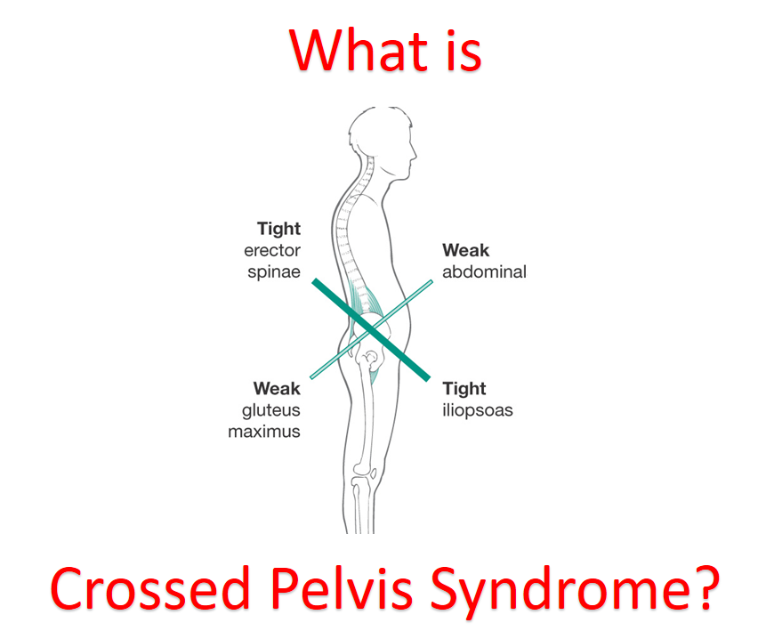 What is Crossed Pelvis Syndrome?