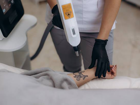 How Much Does The Best Tattoo Removal Boston Really Cost?