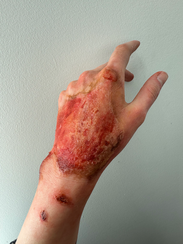 3rd Degree Burns 