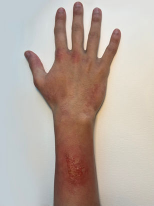 Macrobacterium - Stage 1