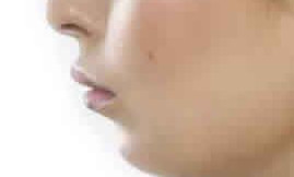 child-retruded-chin-270x199-55.jpg