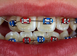 metal-braces-950x534-18.jpg
