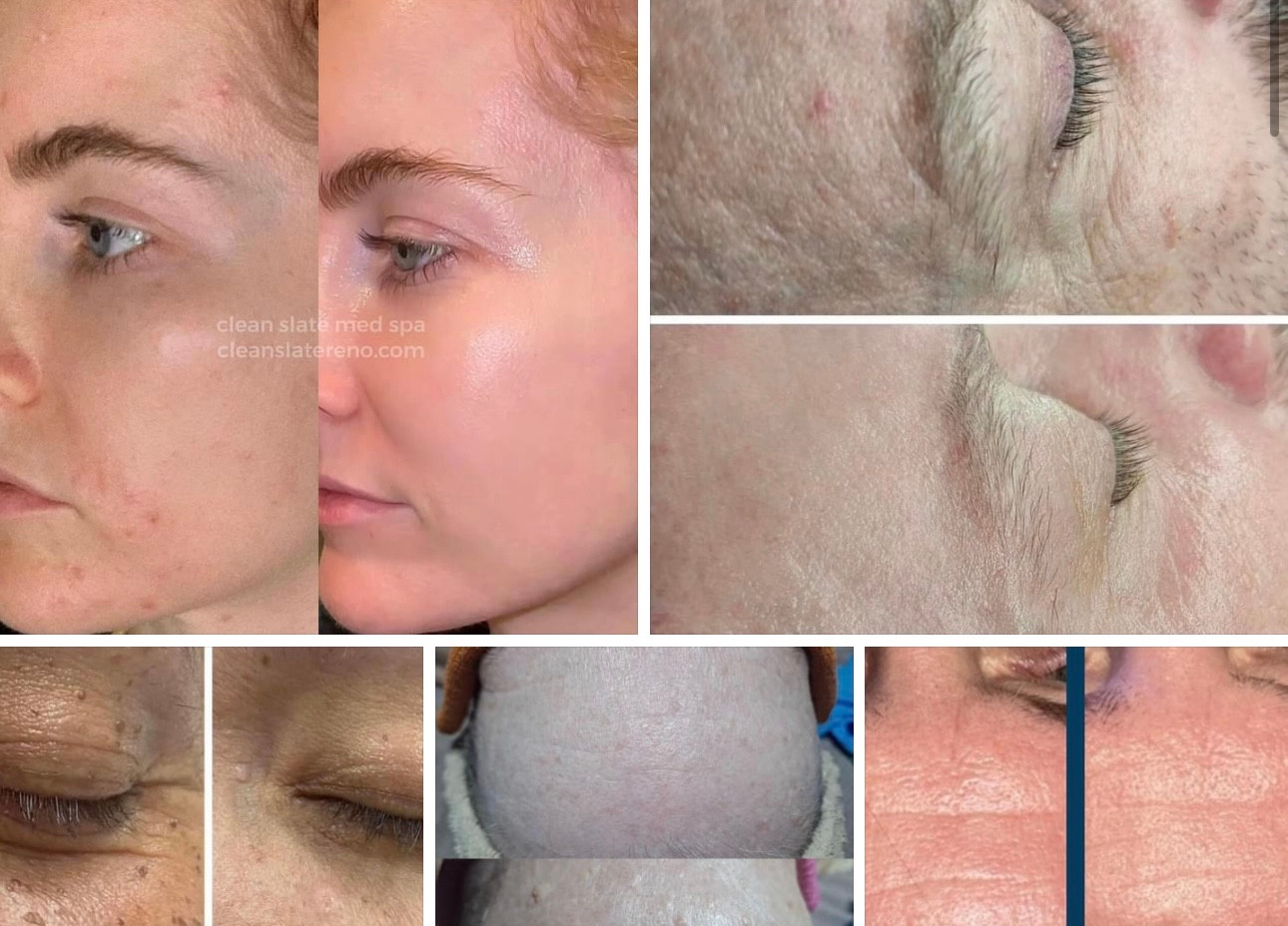 BOOKING Clean Slate Med Spa Reno, NV