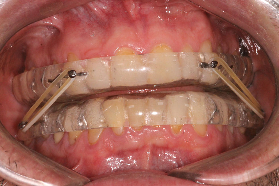 Foto frontal de Aparelho Apnéia do Sono com Pistas/elásticos