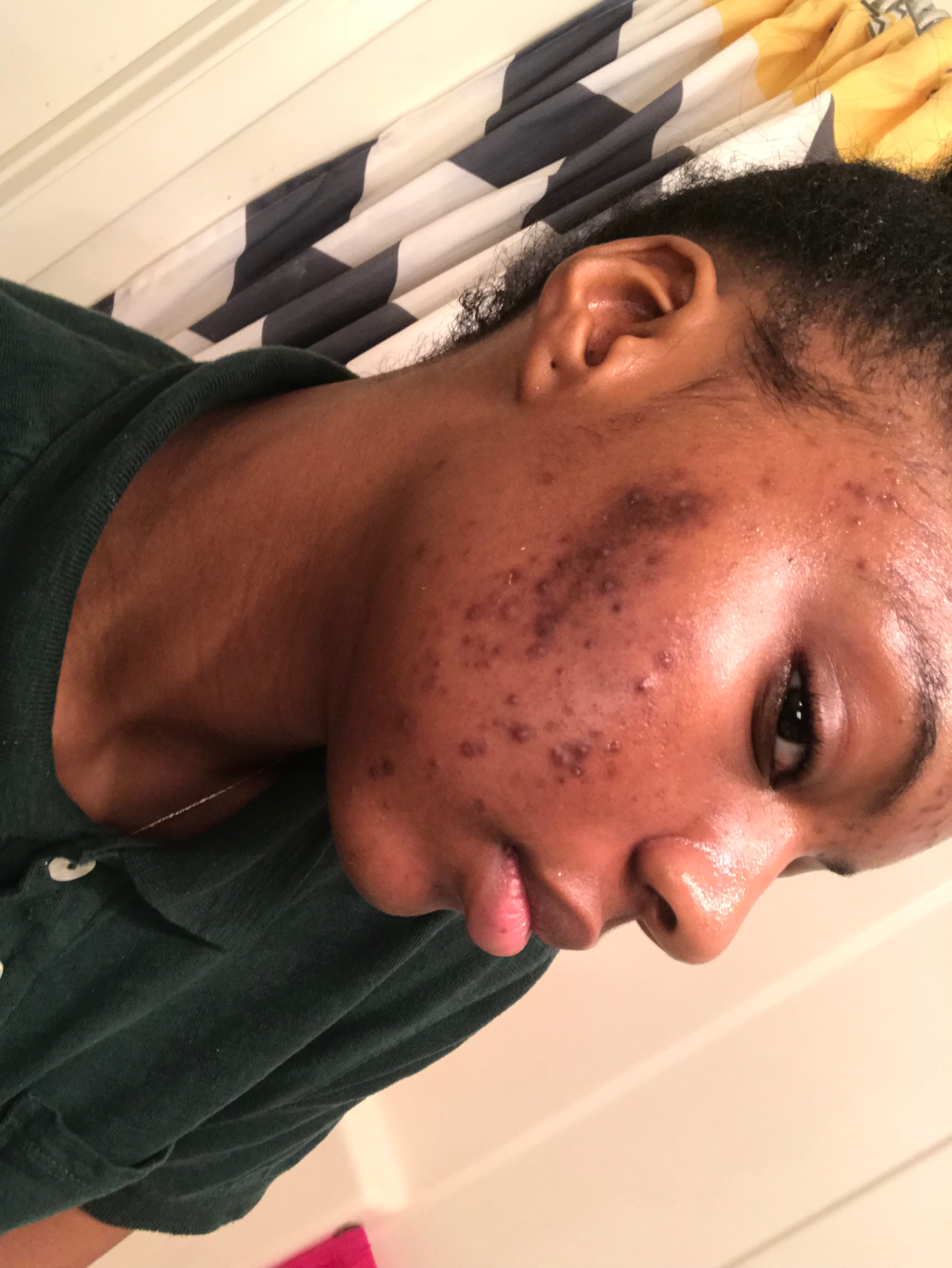 Before using African Black Soap