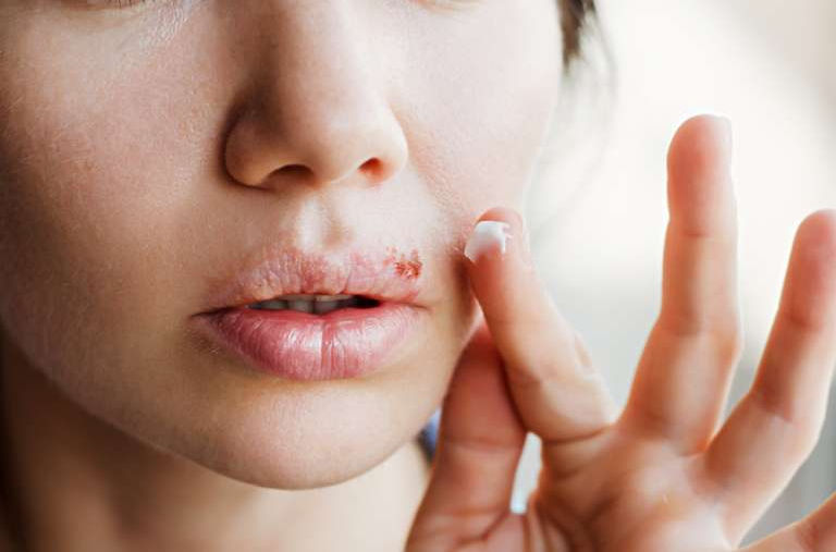 HERPES-SIMPLEX.jpg