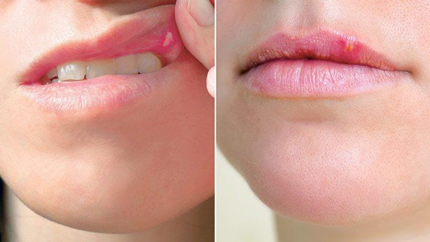 cold-sore-vs-canker-sore-722x406.jpg