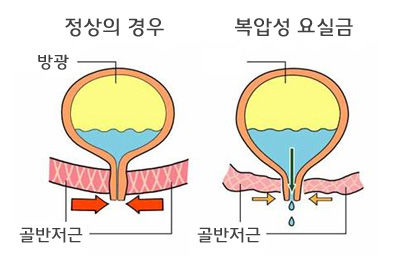 98. 하룻밤 10번 이상 보던 소변 고통이 사라졌어요.