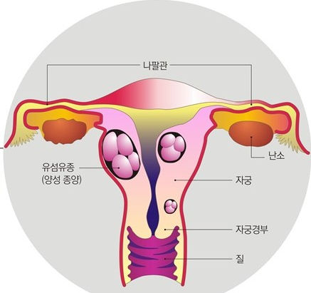 118. 자궁혹과 유산, 불임 그리고 생리통, 생리불순