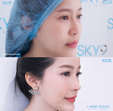 เสริมจมูก sky9