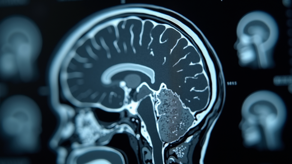Eye-level view of a brain MRI scan showing neurological structures