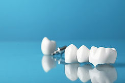 bigstock-Dental-Bridge-With-Crowns-On-L-445468121_1.jpg