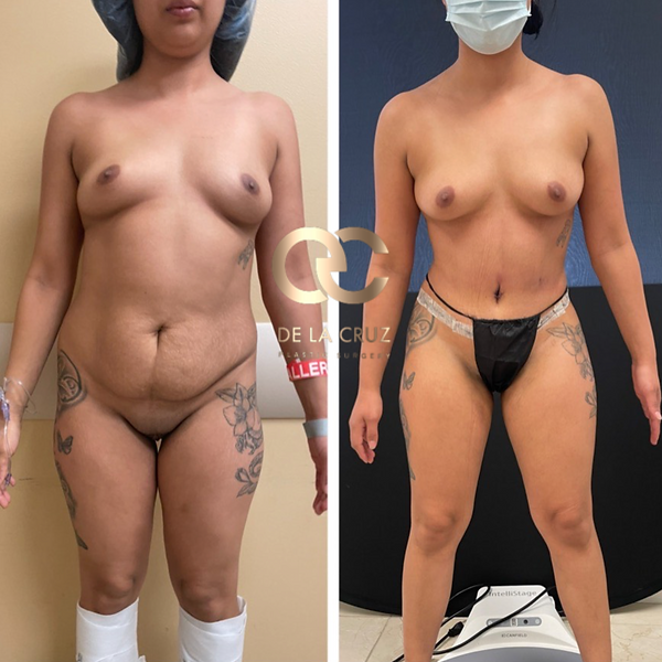 best tummy tuck surgeon abdominoplasty USA Houston Texas.png