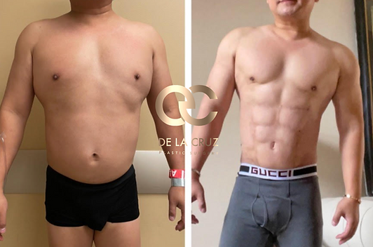 best plastic surgeon hidef lipo 4D VASER.png