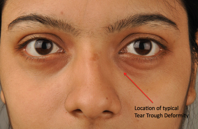 Hyaluronic Acid Injections for Tear Trough Deformities