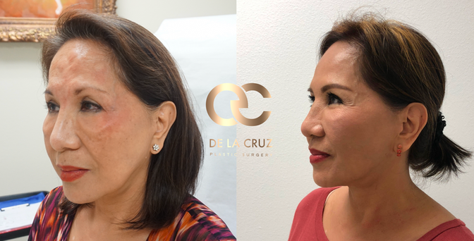 Renuvion vs. FaceTite: The Latest and Most Effective, Non-Surgical Alternatives to Facelift