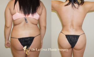 Safety in Large Volume VASER Liposuction