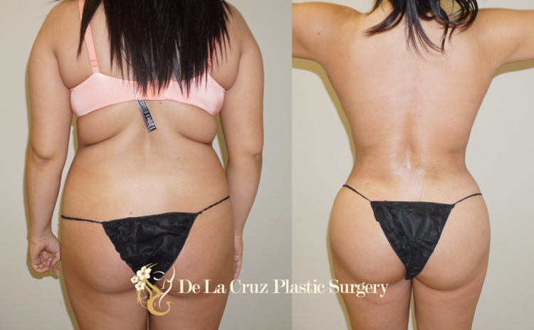 VASER Liposuction with fat transfer to the buttocks (BBL) performed by Dr. De La Cruz.