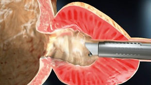 Hipertrofia benigna de prostata