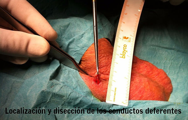 Operación vasectomía sin bisturí
