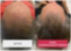 Exosomes hair treatment-2.jpg