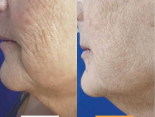 Women's wrinkles visibly reduced