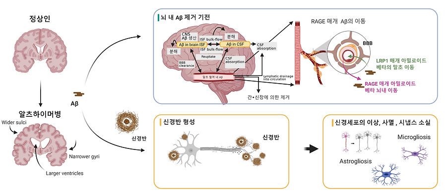 정상과 알츠하이머 뇌의 차이 (1).png