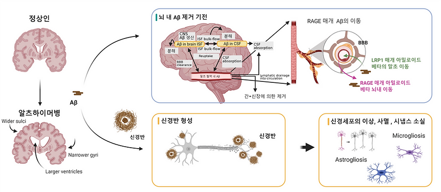 정상과 알츠하이머 뇌의 차이 (1).png