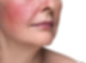 Woman with rosacea and redness / flushing