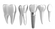 implant dentaire nice