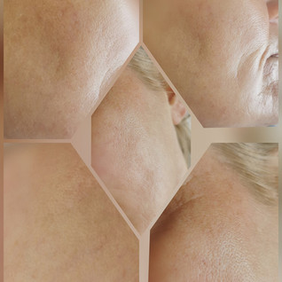 Results photos of microdermabrasion treatment