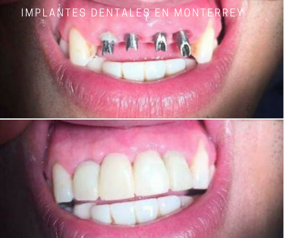 Precios de implantologia dental
