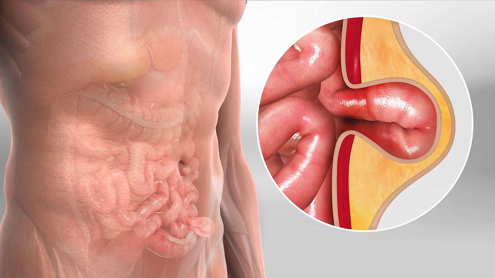 Belly Fat & Hernia Connection: What YouNeed to Know
