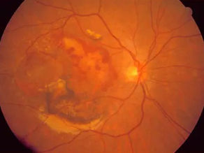 New Data Shows 4D Molecular Therapeutics' Gene Therapy Cuts Eylea Use in Wet AMD Patients