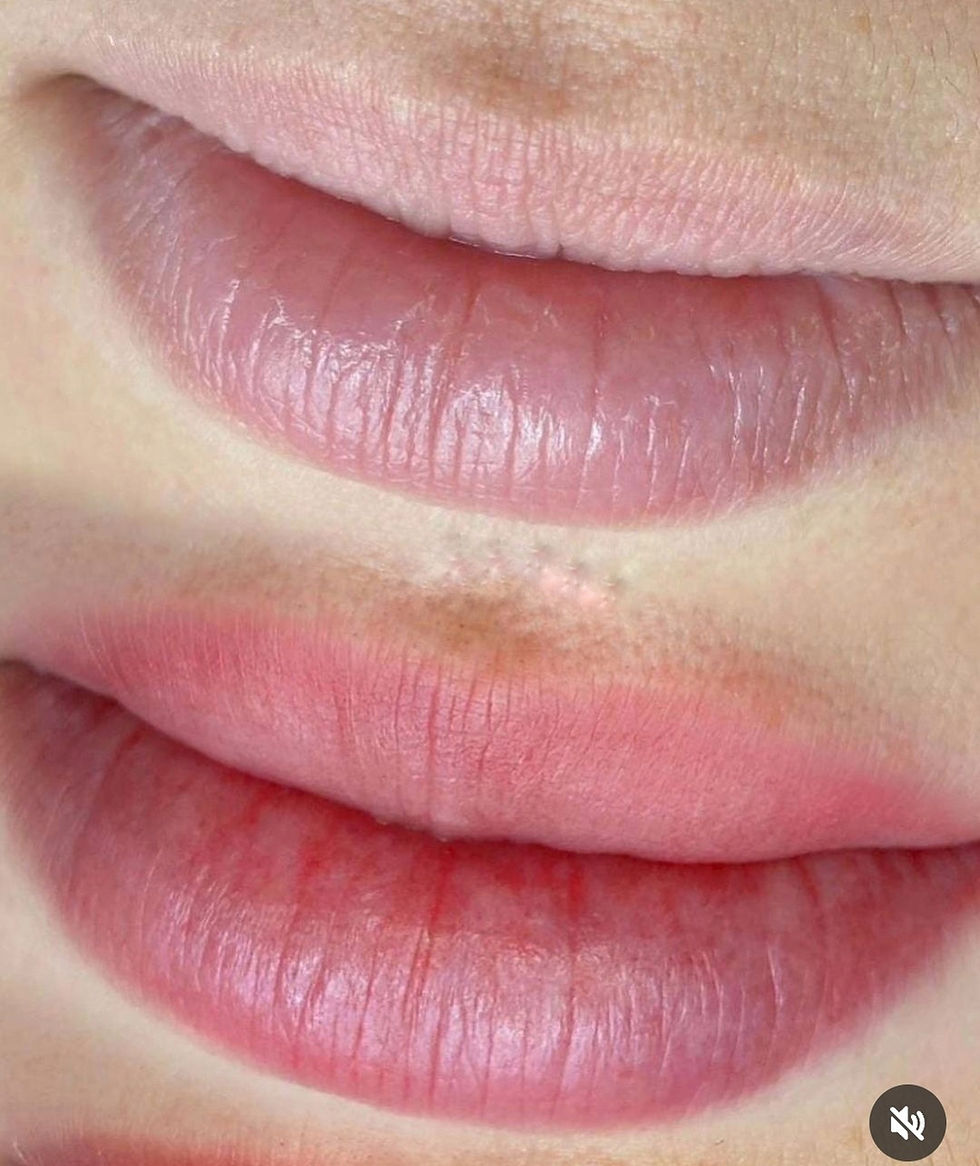 LipBlush Before and After — Symmetry Corrected Doral Miami FL