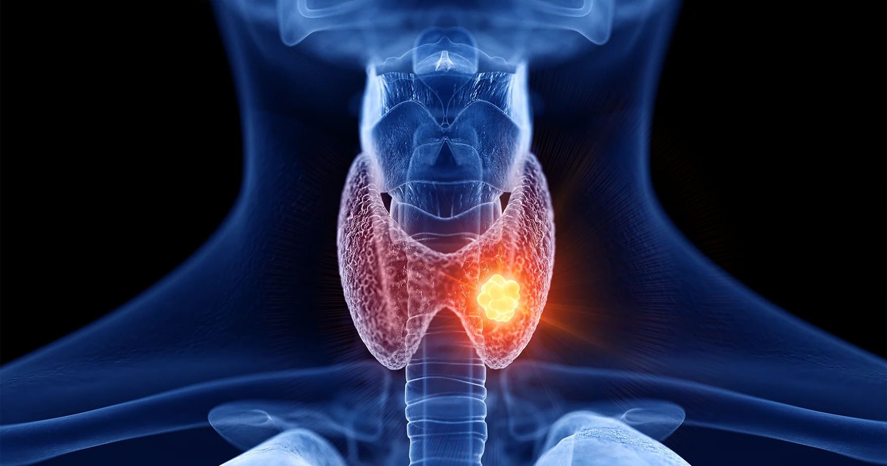 hashimotos_disease_pe_1796x943.webp