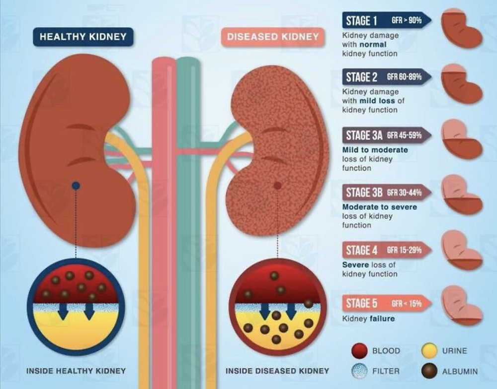 Signs of Chronic Kidney Disease