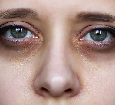what-causes-dark-circles-under-eyes.webp
