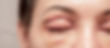eyelid.jpeg