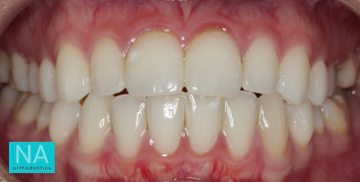 Patient Before Invisalign